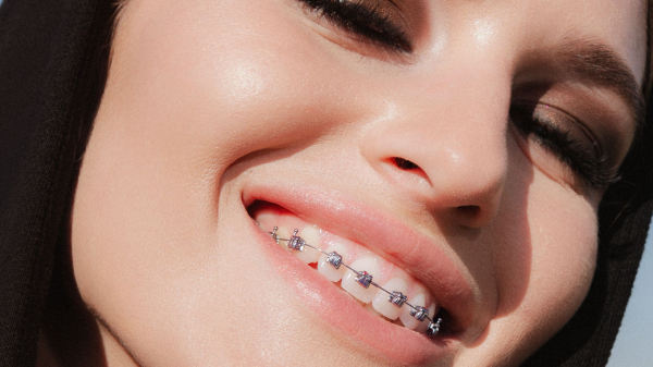 An Adult’s Guide to Getting Braces